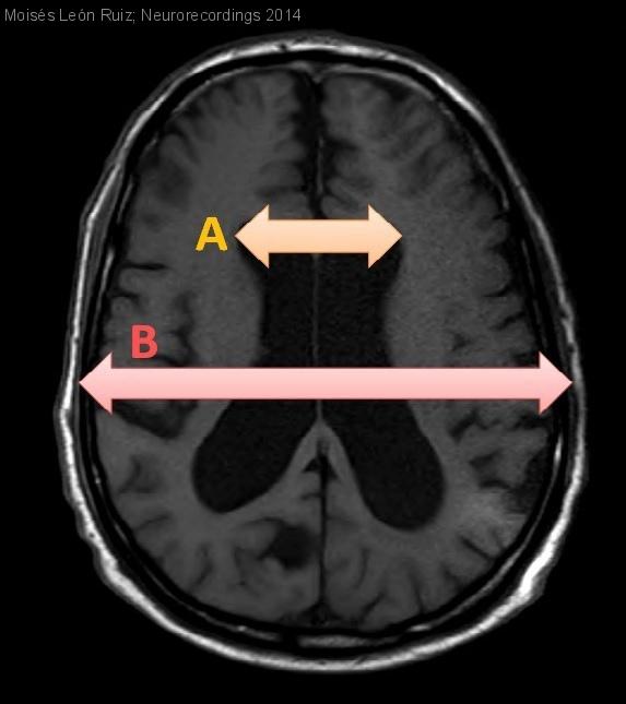 Debut ClÍnico Con DÉficit Frontotemporal De Una Hidrocefalia CrÓnica Del Adulto ¿azar O Algo 3722